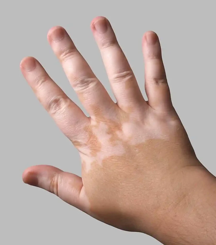 소아백반증 손등증상